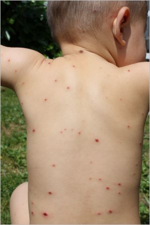A Toddler Skin Rash Could Be Irritating And Painfully ...