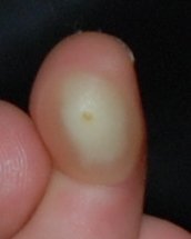 Blister on 3 yr old daughters finger